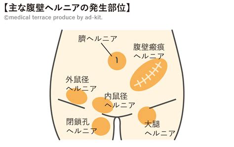 水戸 鼠径部|水戸市の鼠径ヘルニア(そけいヘルニア)/脱腸の専門治療が可能。